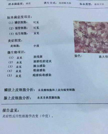 陰道分泌物麻豆AV传媒蜜桃天美传媒廠家教你查看陰道分泌物檢測報告