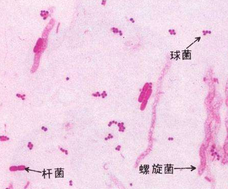 婦科白帶麻豆AV传媒蜜桃天美传媒廠家分析白帶線索細胞陽性的意義