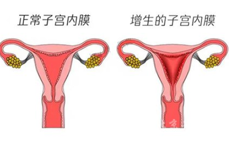 白帶常規麻豆AV传媒蜜桃天美传媒廠家解讀子宮內膜增生是什麽原因引起的